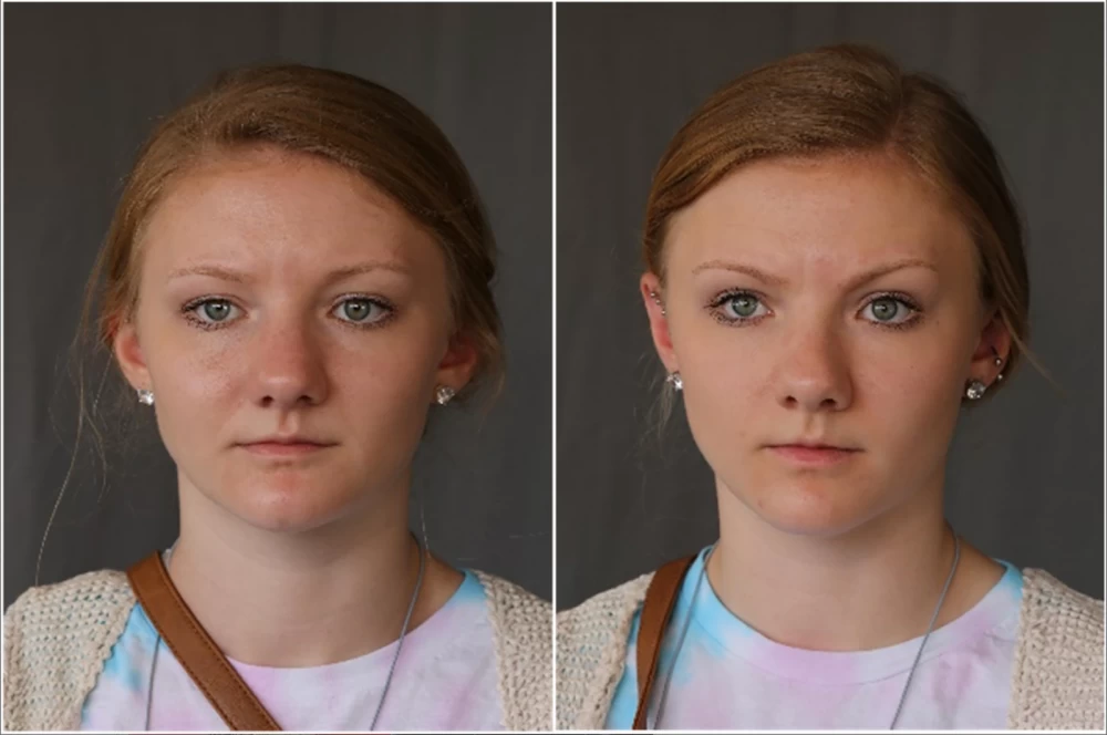 Example of a pair of monozygotic twins