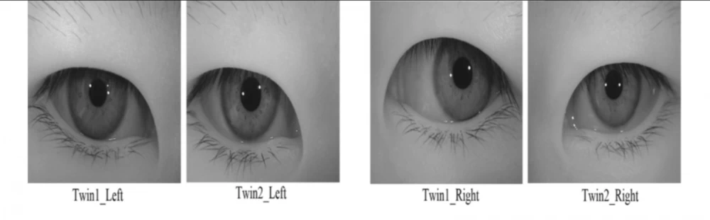 Image of monozygotic twins' eyes